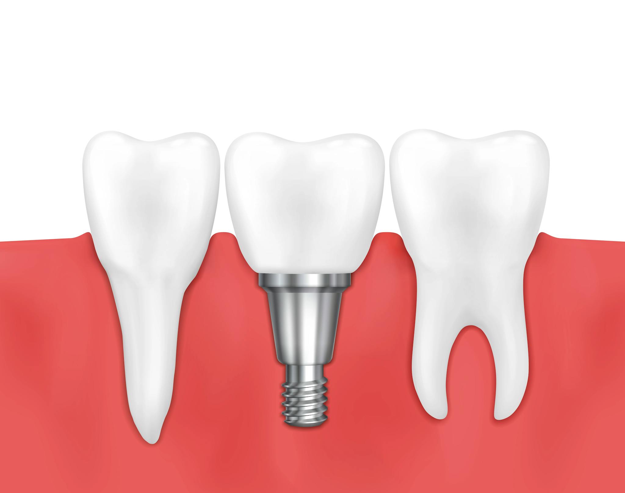 Esquema implante dental